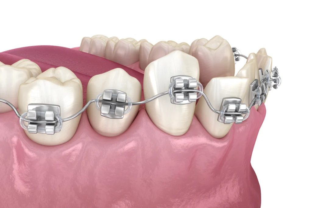 appareil dentaire metallique Appareil dentaire métallique Orthodontistes à La Roche-sur-Yon | Cabinet 7SMILE